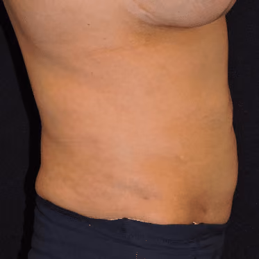 Liposuction before and after, case 7197 - Cool Springs Plastic Surgery