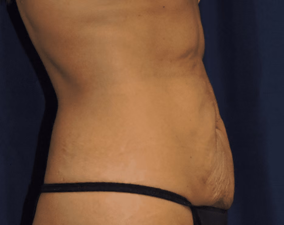 Tummy Tuck before and after, case 7340 - Cool Springs Plastic Surgery