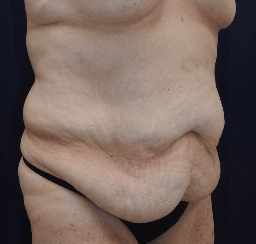 Tummy Tuck before and after, case 7441 - Cool Springs Plastic Surgery