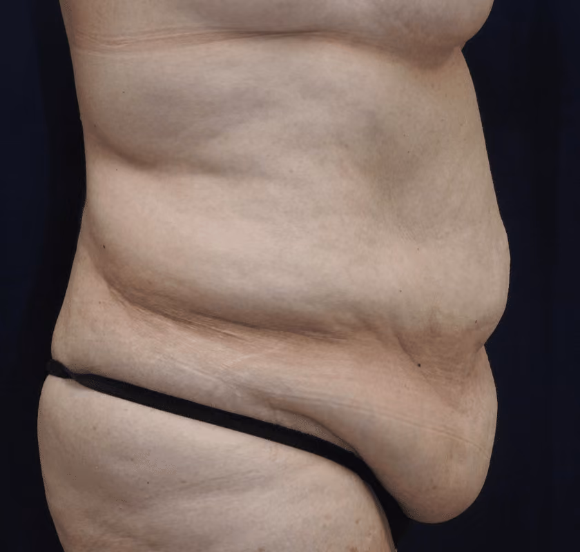 Tummy Tuck before and after, case 7441 - Cool Springs Plastic Surgery