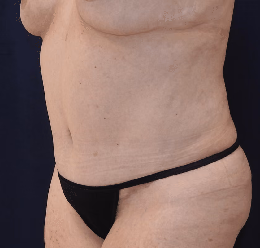 Tummy Tuck before and after, case 7441 - Cool Springs Plastic Surgery