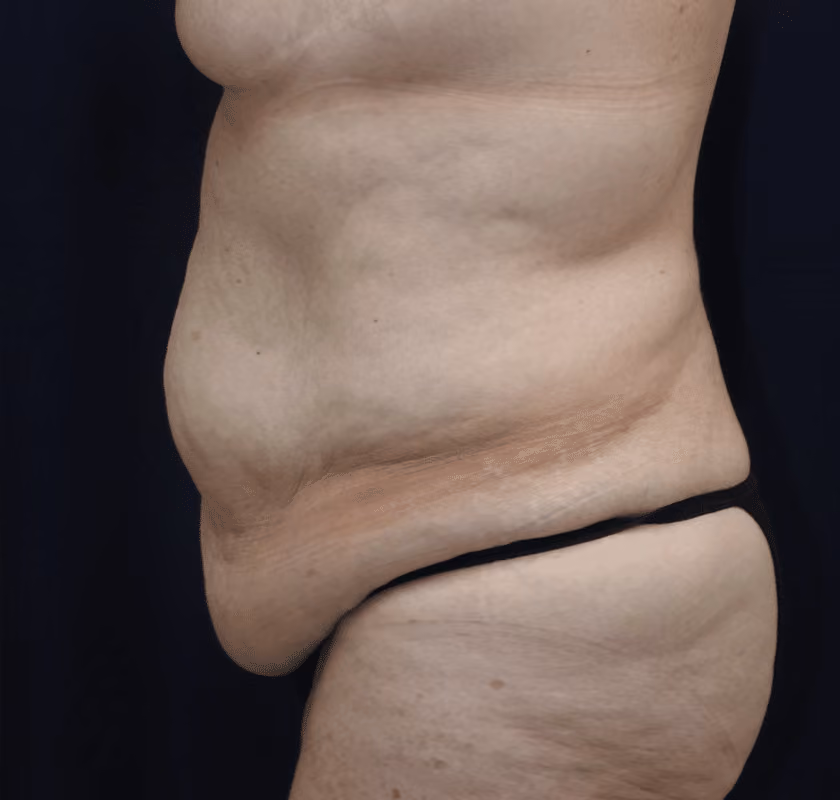 Tummy Tuck before and after, case 7441 - Cool Springs Plastic Surgery