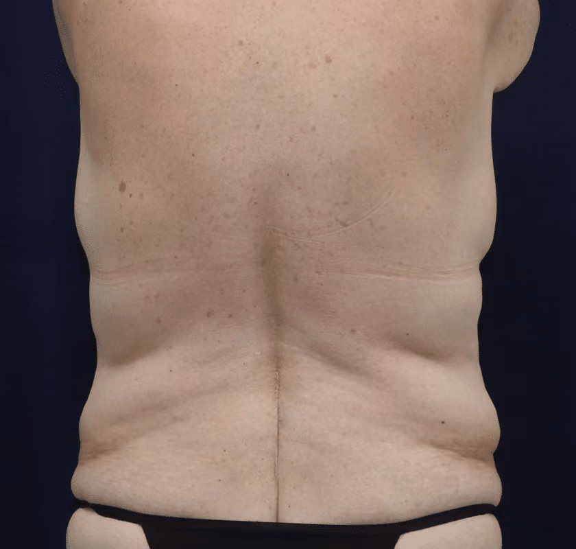Tummy Tuck before and after, case 7441 - Cool Springs Plastic Surgery