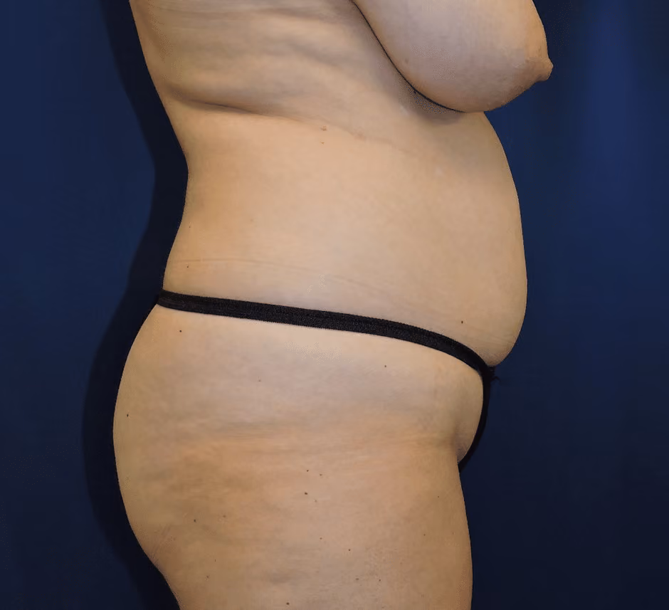 Tummy Tuck before and after, case 7568 - Cool Springs Plastic Surgery