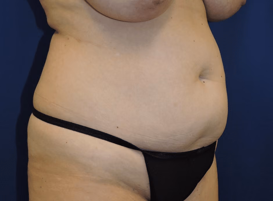 Tummy Tuck before and after, case 7568 - Cool Springs Plastic Surgery