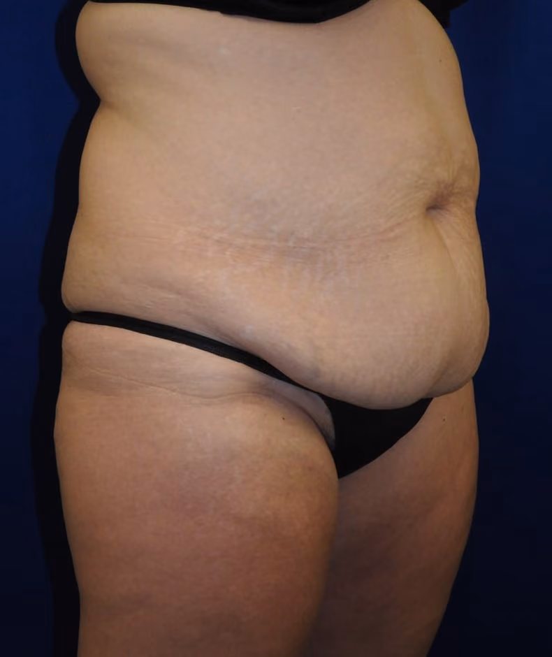 Tummy Tuck before and after, case 7648 - Cool Springs Plastic Surgery
