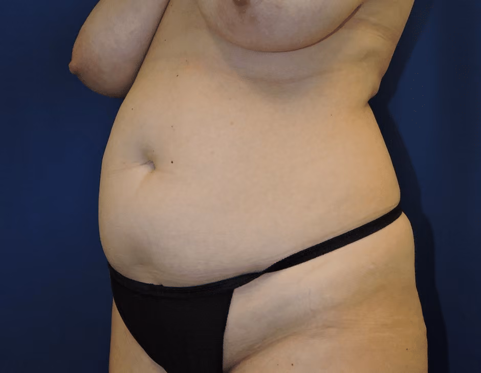 Tummy Tuck before and after, case 7568 - Cool Springs Plastic Surgery