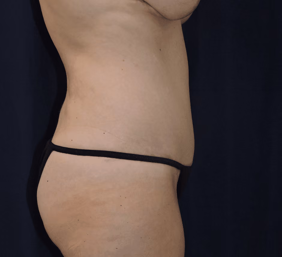 Tummy Tuck before and after, case 7568 - Cool Springs Plastic Surgery