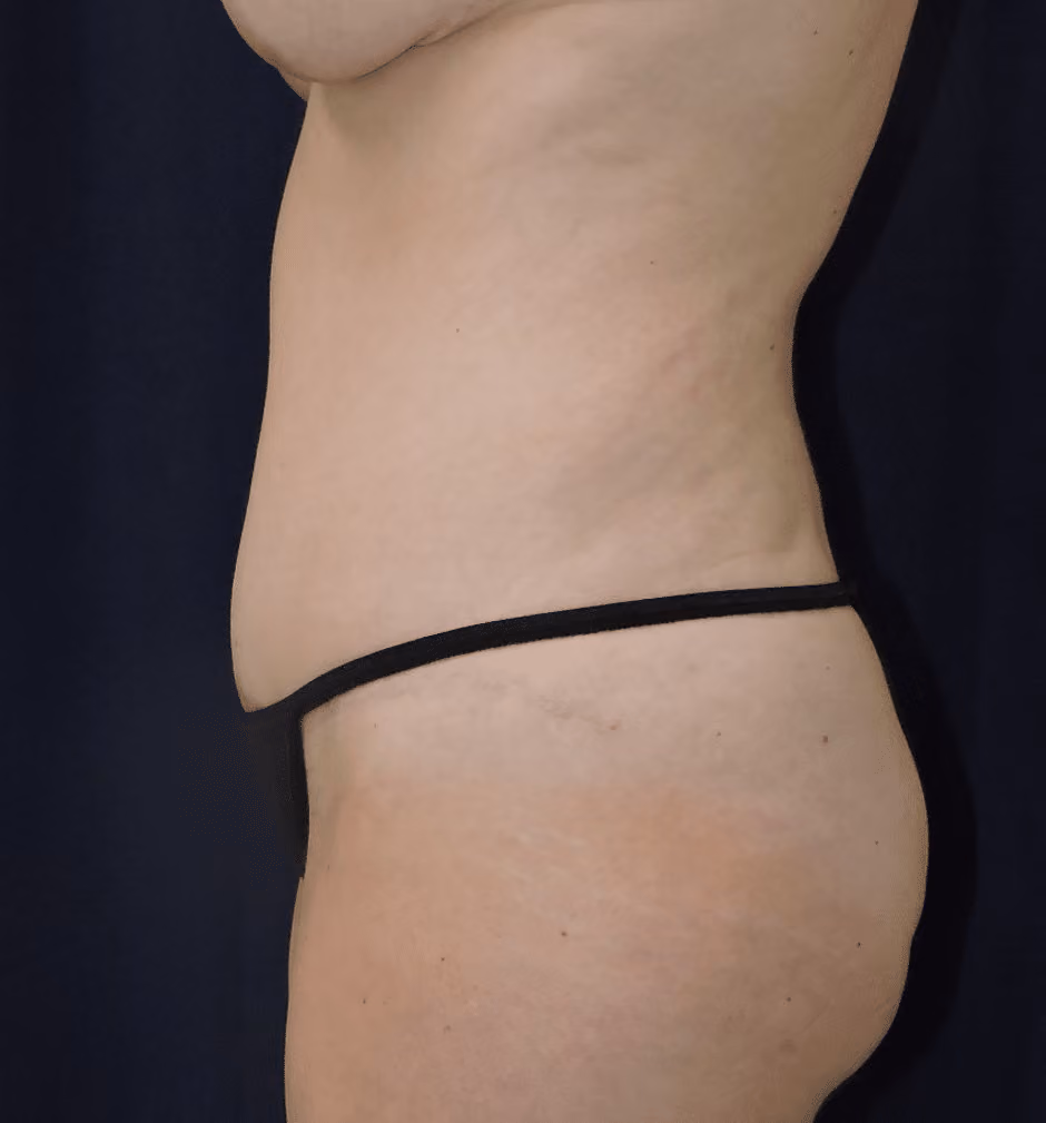 Tummy Tuck before and after, case 7568 - Cool Springs Plastic Surgery
