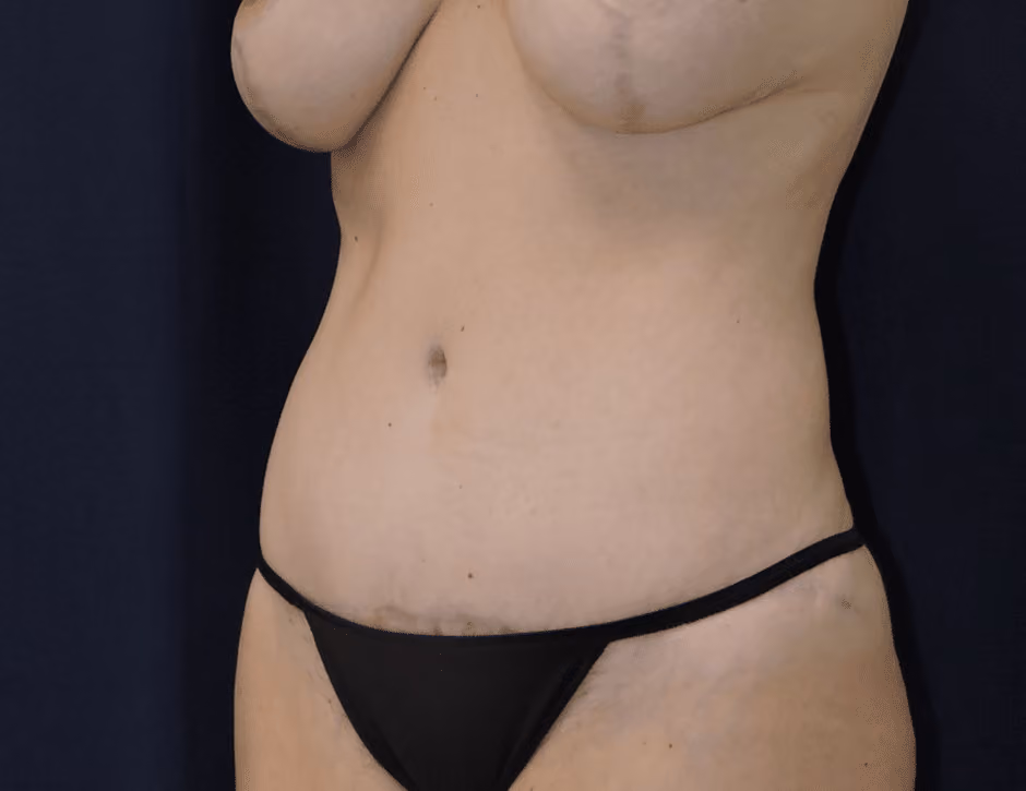 Tummy Tuck before and after, case 7568 - Cool Springs Plastic Surgery