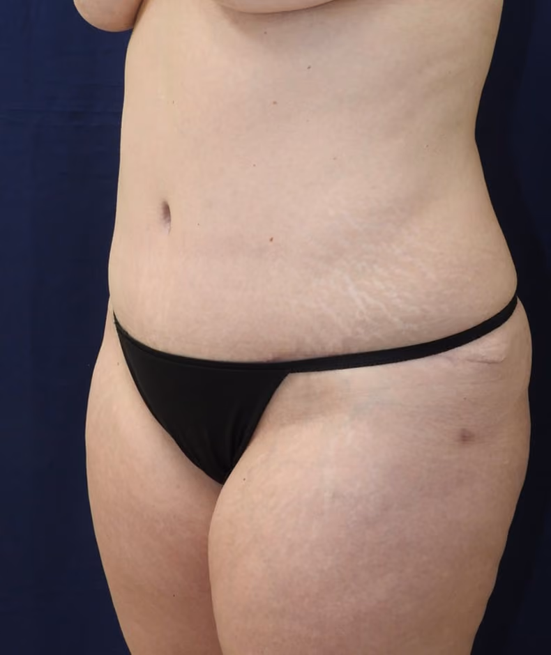 Tummy Tuck before and after, case 7648 - Cool Springs Plastic Surgery