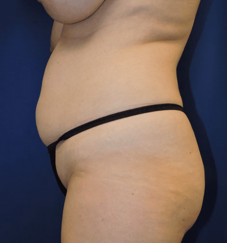 Tummy Tuck before and after, case 7568 - Cool Springs Plastic Surgery
