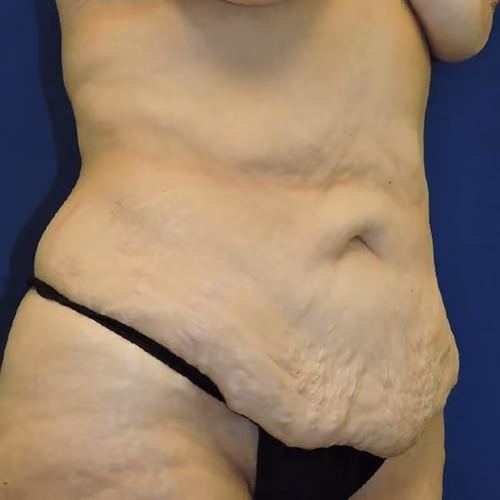 Tummy Tuck before and after, case 7769 - Cool Springs Plastic Surgery