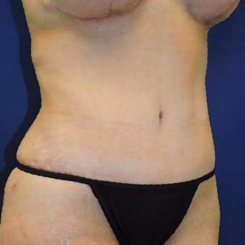 Tummy Tuck before and after, case 7769 - Cool Springs Plastic Surgery