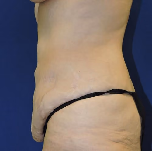 Tummy Tuck before and after, case 7769 - Cool Springs Plastic Surgery
