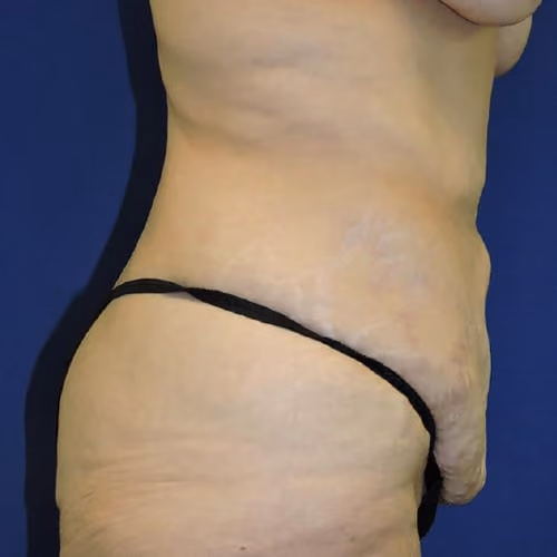Tummy Tuck before and after, case 7769 - Cool Springs Plastic Surgery