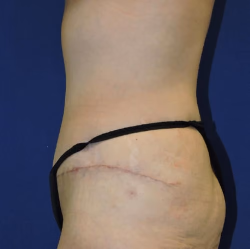 Tummy Tuck before and after, case 7769 - Cool Springs Plastic Surgery