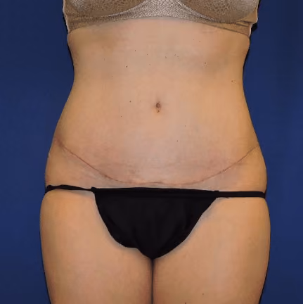 Tummy Tuck before and after, case 7847 - Cool Springs Plastic Surgery