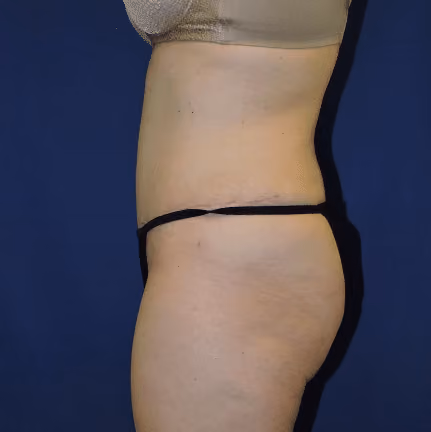 Tummy Tuck before and after, case 7847 - Cool Springs Plastic Surgery
