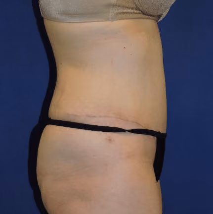 Tummy Tuck before and after, case 7847 - Cool Springs Plastic Surgery