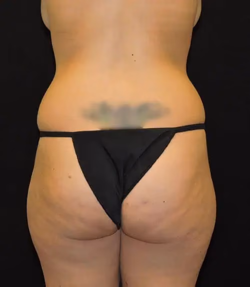 Tummy Tuck before and after, case 8057 - Cool Springs Plastic Surgery