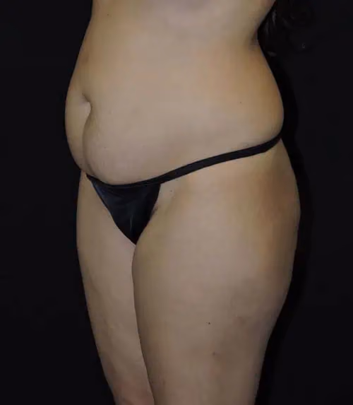 Tummy Tuck before and after, case 8057 - Cool Springs Plastic Surgery