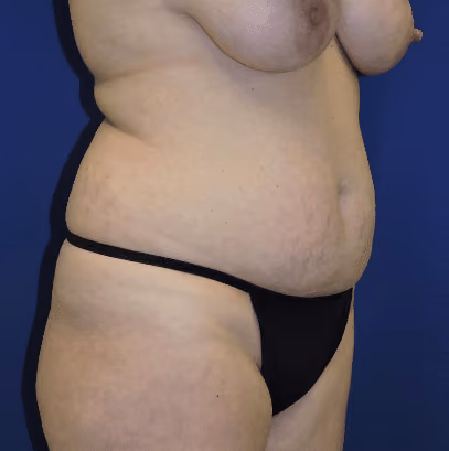 Tummy Tuck before and after, case 8402 - Cool Springs Plastic Surgery