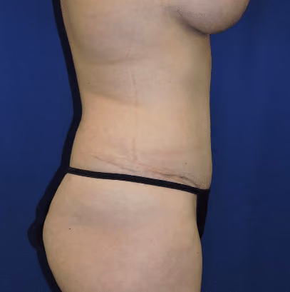 Tummy Tuck before and after, case 8402 - Cool Springs Plastic Surgery