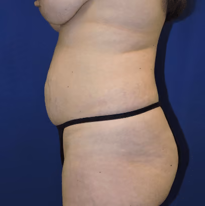 Tummy Tuck before and after, case 8402 - Cool Springs Plastic Surgery