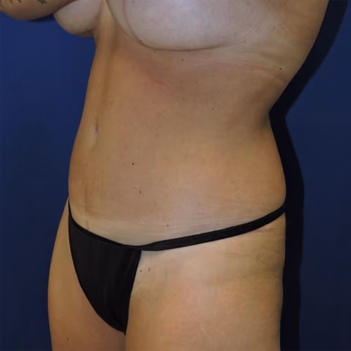 Tummy Tuck before and after, case 8562 - Cool Springs Plastic Surgery