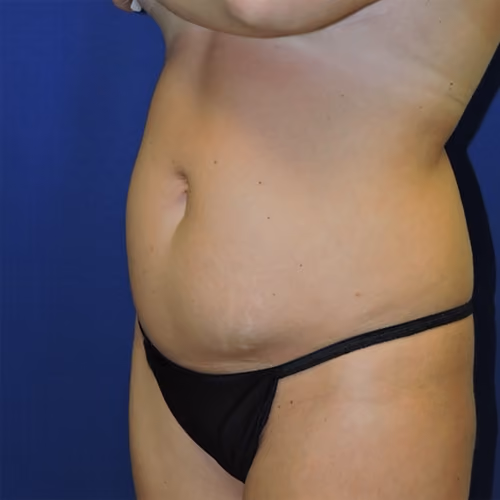 Tummy Tuck before and after, case 8562 - Cool Springs Plastic Surgery