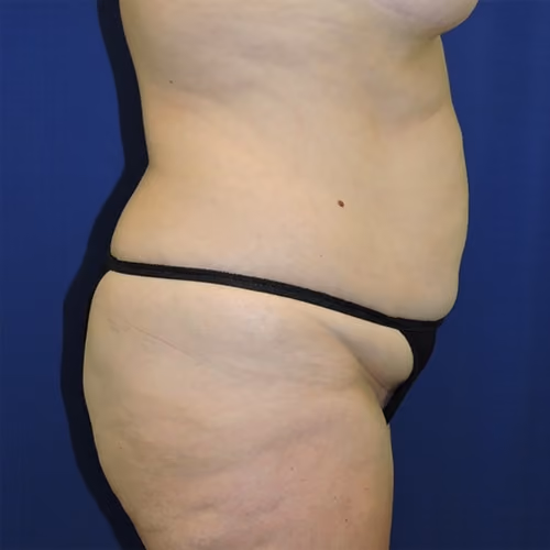 Tummy Tuck before and after, case 8767 - Cool Springs Plastic Surgery