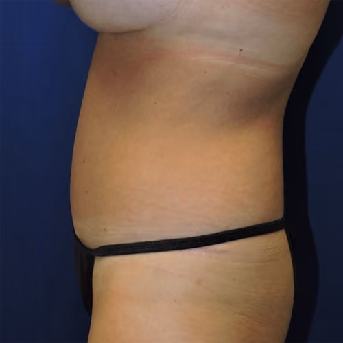 Tummy Tuck before and after, case 8562 - Cool Springs Plastic Surgery