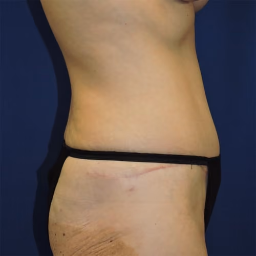 Tummy Tuck before and after, case 8884 - Cool Springs Plastic Surgery