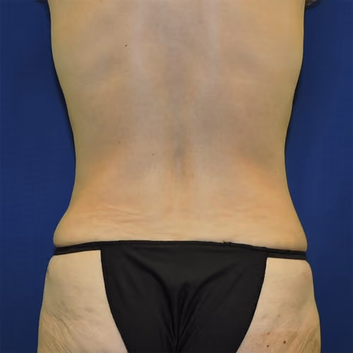 Tummy Tuck before and after, case 8884 - Cool Springs Plastic Surgery