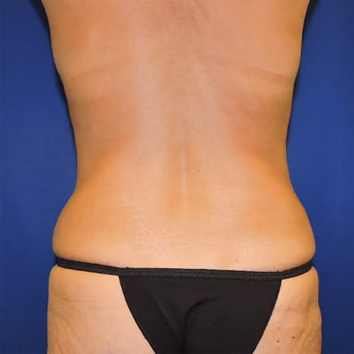 Tummy Tuck before and after, case 8884 - Cool Springs Plastic Surgery