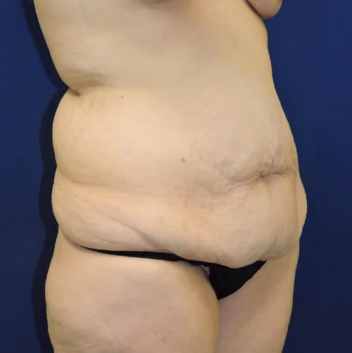 Tummy Tuck before and after, case 9035 - Cool Springs Plastic Surgery