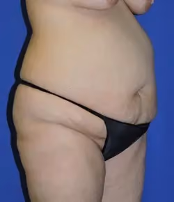 Tummy Tuck before and after, case 9542 - Cool Springs Plastic Surgery