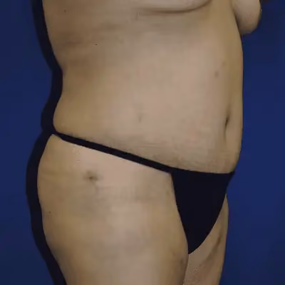 Tummy Tuck before and after, case 9604 - Cool Springs Plastic Surgery