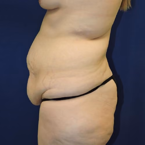 Tummy Tuck before and after, case 9035 - Cool Springs Plastic Surgery