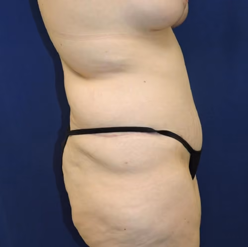 Tummy Tuck before and after, case 9035 - Cool Springs Plastic Surgery