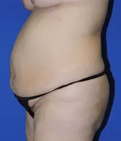 Tummy Tuck before and after, case 9542 - Cool Springs Plastic Surgery
