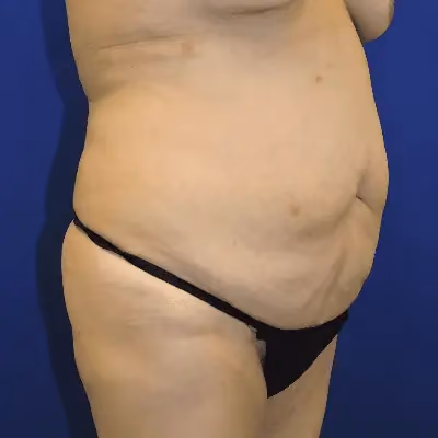Tummy Tuck before and after, case 9604 - Cool Springs Plastic Surgery