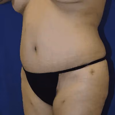 Tummy Tuck before and after, case 9604 - Cool Springs Plastic Surgery