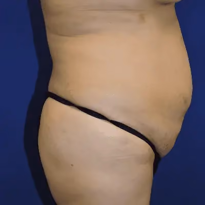 Tummy Tuck before and after, case 9604 - Cool Springs Plastic Surgery