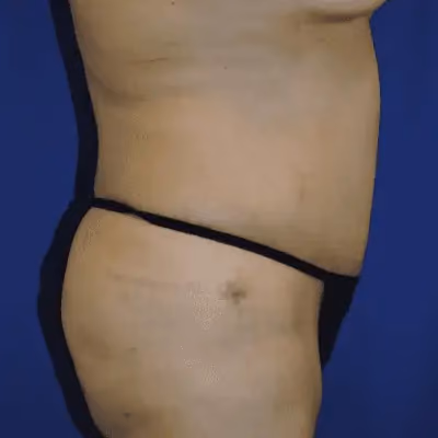 Tummy Tuck before and after, case 9604 - Cool Springs Plastic Surgery