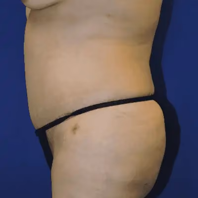 Tummy Tuck before and after, case 9604 - Cool Springs Plastic Surgery