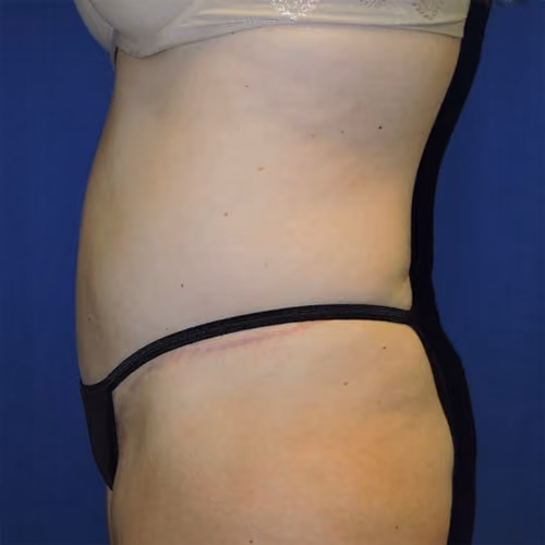 Tummy Tuck before and after, case 9648 - Cool Springs Plastic Surgery