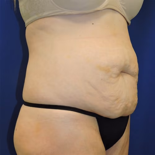 Tummy Tuck before and after, case 9648 - Cool Springs Plastic Surgery