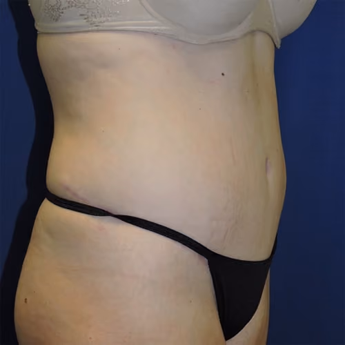 Tummy Tuck before and after, case 9648 - Cool Springs Plastic Surgery